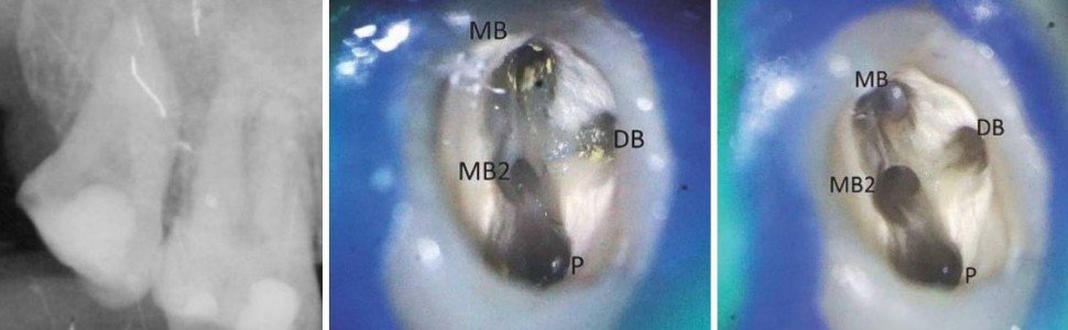 Leczenie endodontyczne zębów trzonowych trzecich