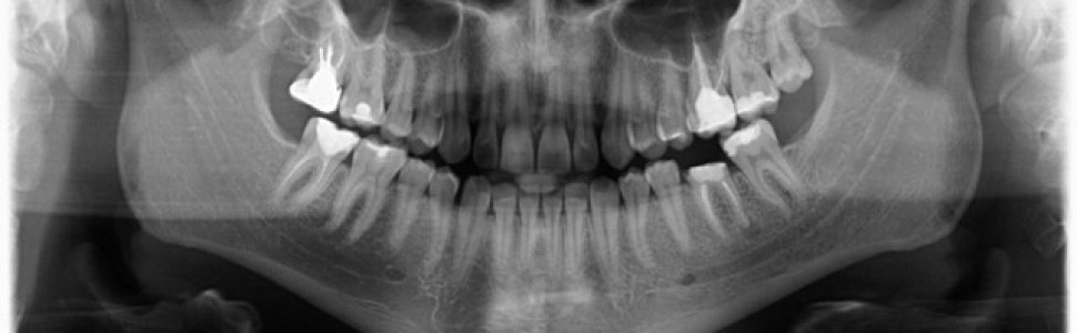 Zabieg implantacji natychmiastowej w żuchwie przeprowadzony przy użyciu nawigacji komputerowej i szablonu chirurgicznego