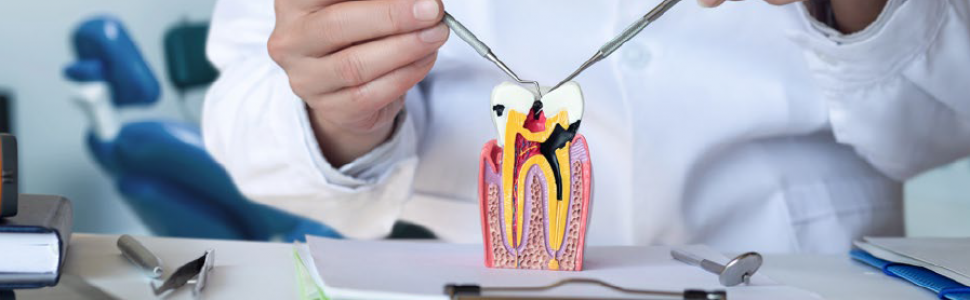STRESZCZENIA. Perły szkliwne – przyczyna zlokalizowanego zapalenia przyzębia 
