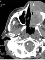 Diagnostyka obrazowa zatok szczękowych dla lekarzy dentystów