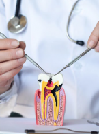 STRESZCZENIA. Perły szkliwne – przyczyna zlokalizowanego zapalenia przyzębia 